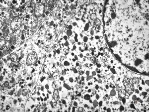 M, 62y. | pheochromocytoma M, 62y. | pheochromocytoma